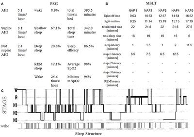 Cognitive Behavioral Therapy for Insomnia as Adjunctive Therapy to Antipsychotics in Schizophrenia: A Case Report